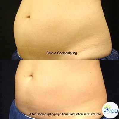 Coolsculpting on Obese Patients